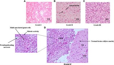 Cytochrome C as a potential clinical marker for diagnosis and treatment of glioma